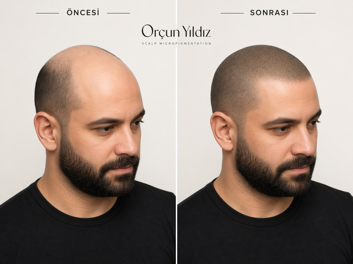 Tepe bölgesi saç simülasyonu öncesi sonrası yoğunluk etkisi örneği