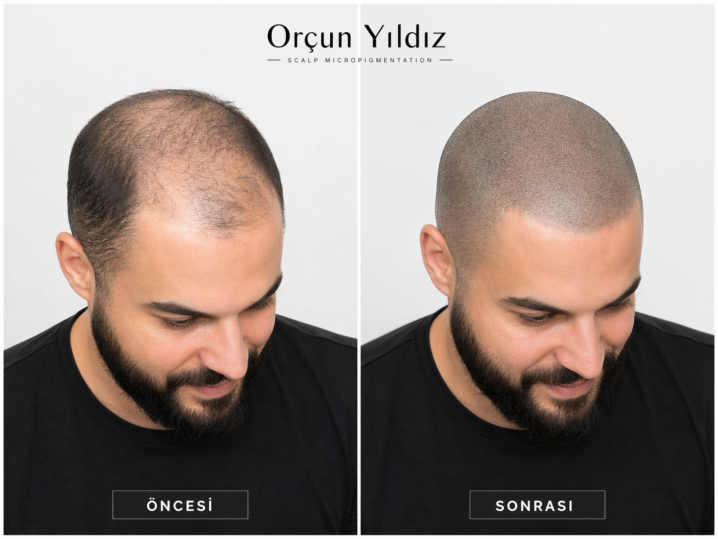 Kadın saç seyrekliği çözümü öncesi sonrası doğal saç simülasyonu örneği