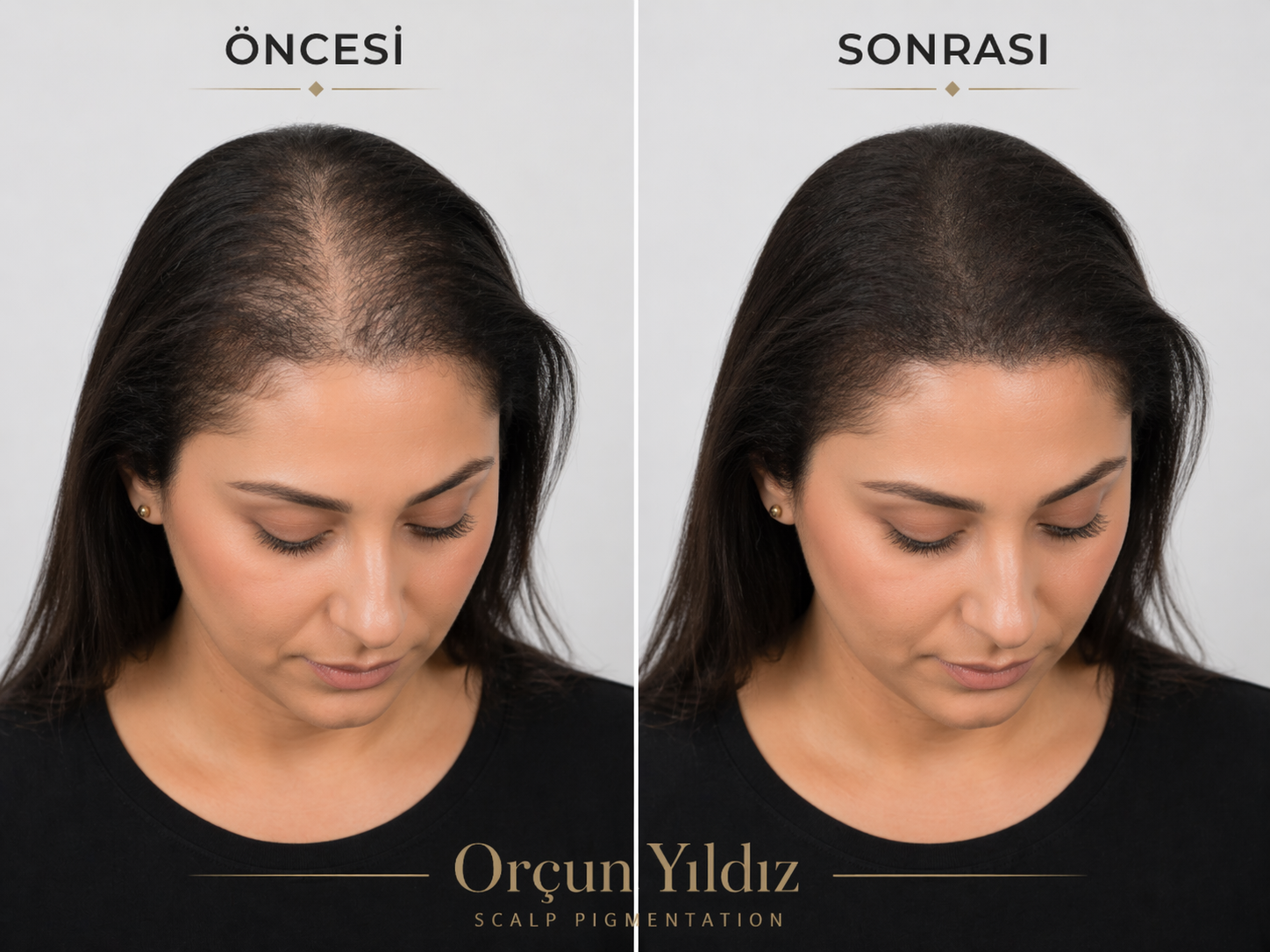 Kadın öncesi sonrası saç simülasyonu ile doğal yoğunluk görünümü örneği