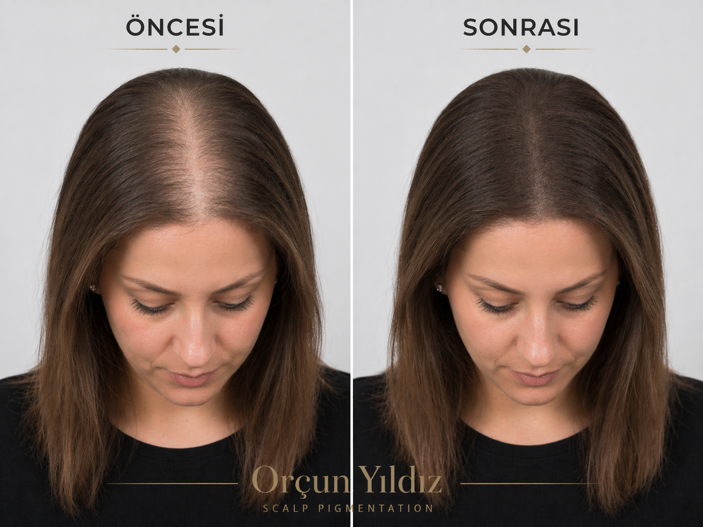 Saç simülasyonu merkezi kadın saç yoğunluğu öncesi sonrası örneği