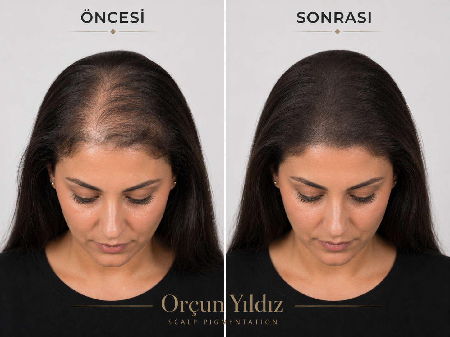 Kadın kafa derisi mikropigmentasyonu ile saç seyrekliği çözümü örneği