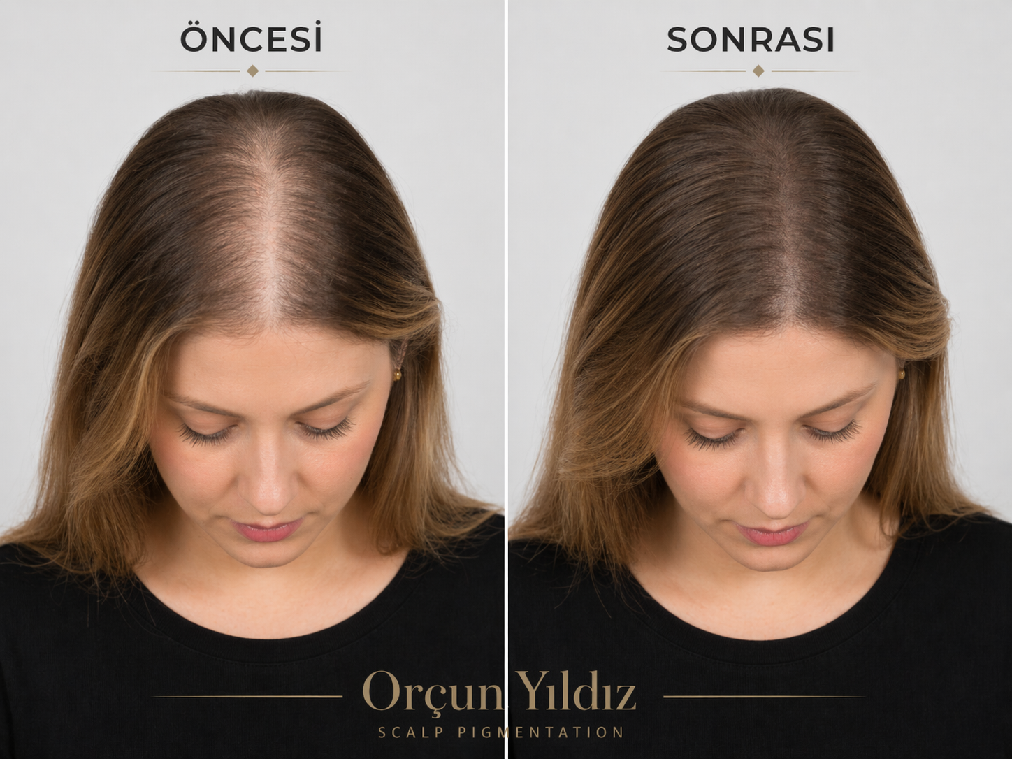 Kadın doğal saç simülasyonu öncesi sonrası üst bölge kapatıcılık örneği