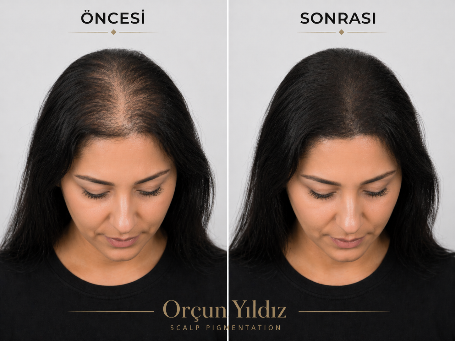 Kadın saç çizgisi ve saç yoğunluğu öncesi sonrası doğal görünüm örneği