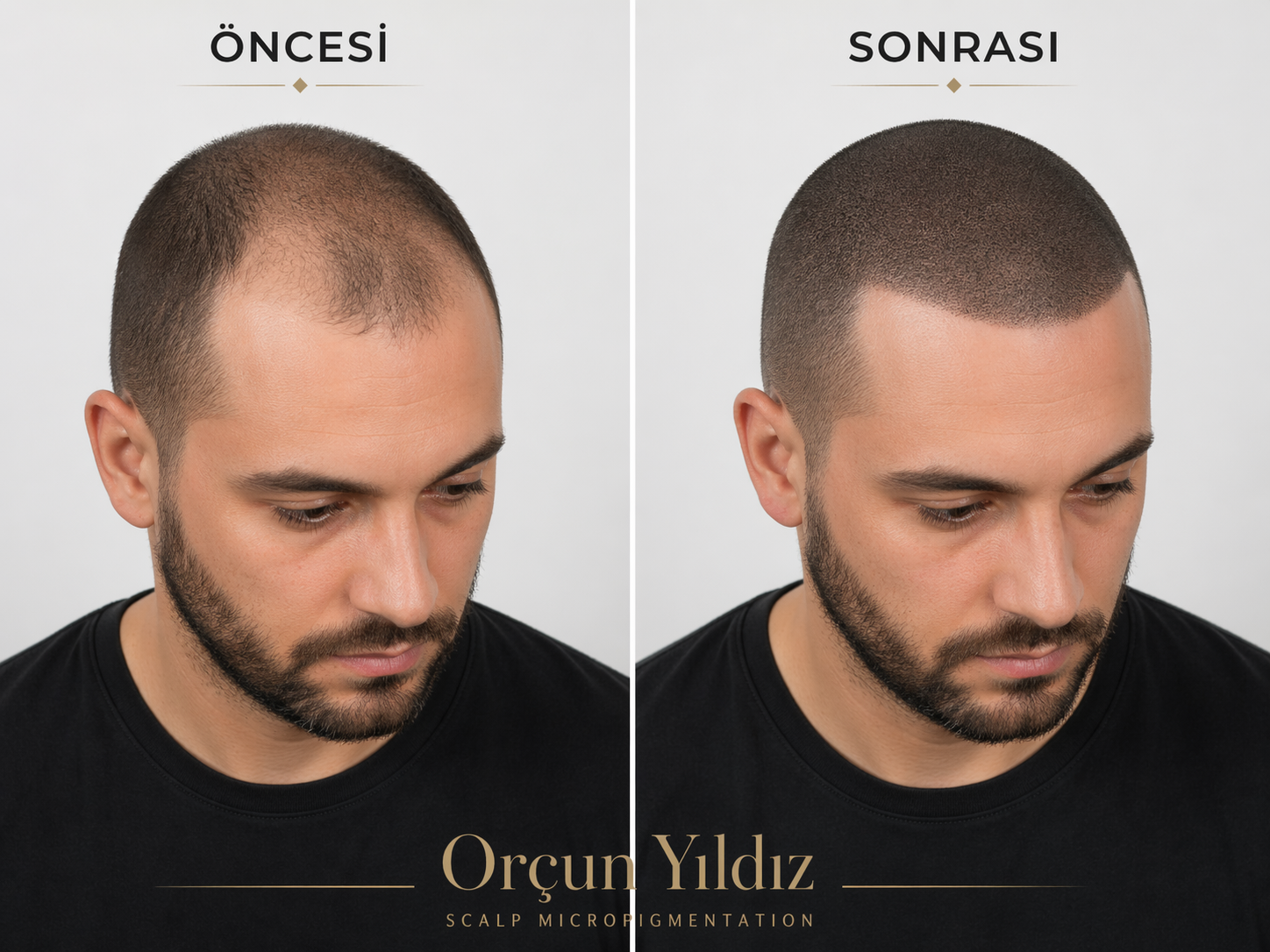 Adana saç simülasyonu öncesi sonrası alın çizgisi saç simülasyonu örneği