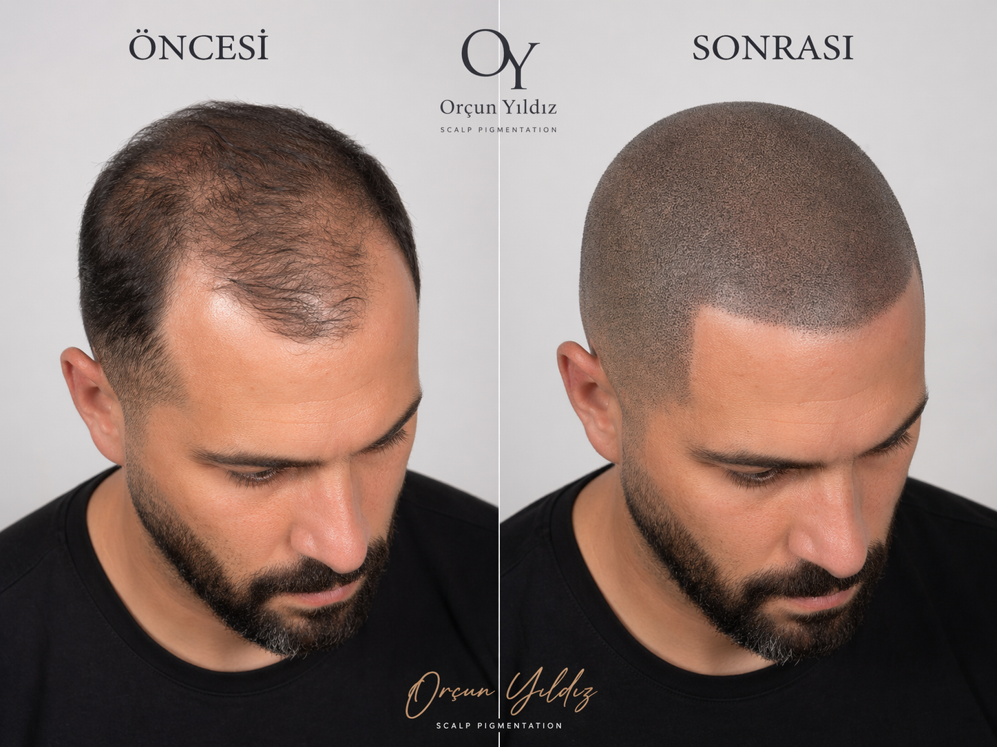 Saç seyrekliği çözümü için öncesi sonrası saç simülasyonu örneği