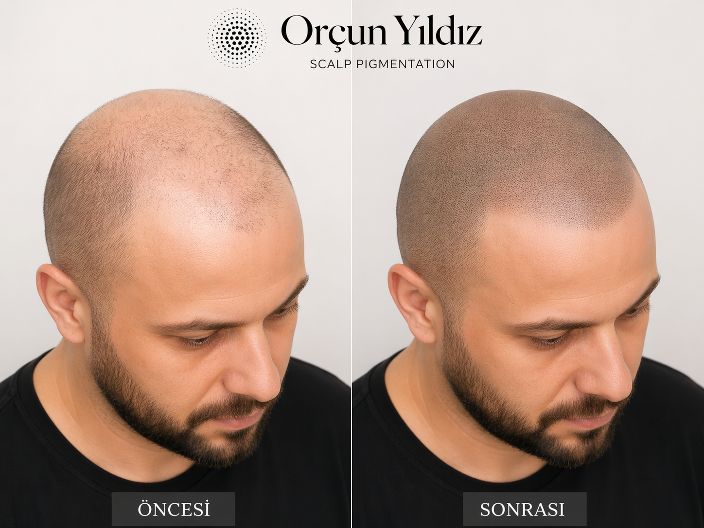 Kafa derisi mikropigmentasyonu ve saç gölgelendirme öncesi sonrası örneği